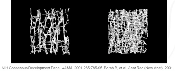 Comparing structure of bones with osteoperosis (right) to healthy bones (left)